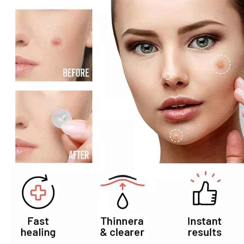 Chin Acne Patch for Day and Night Use - Repair Acne Effectively