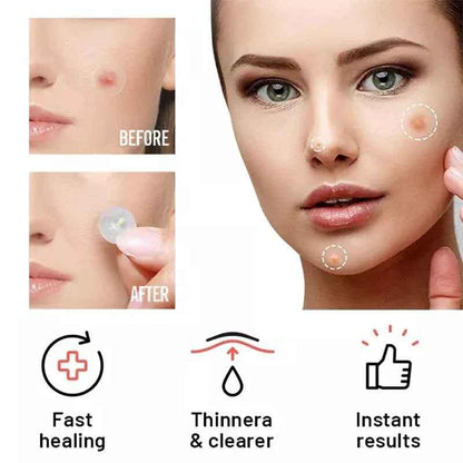 Chin Acne Patch for Day and Night Use - Repair Acne Effectively
